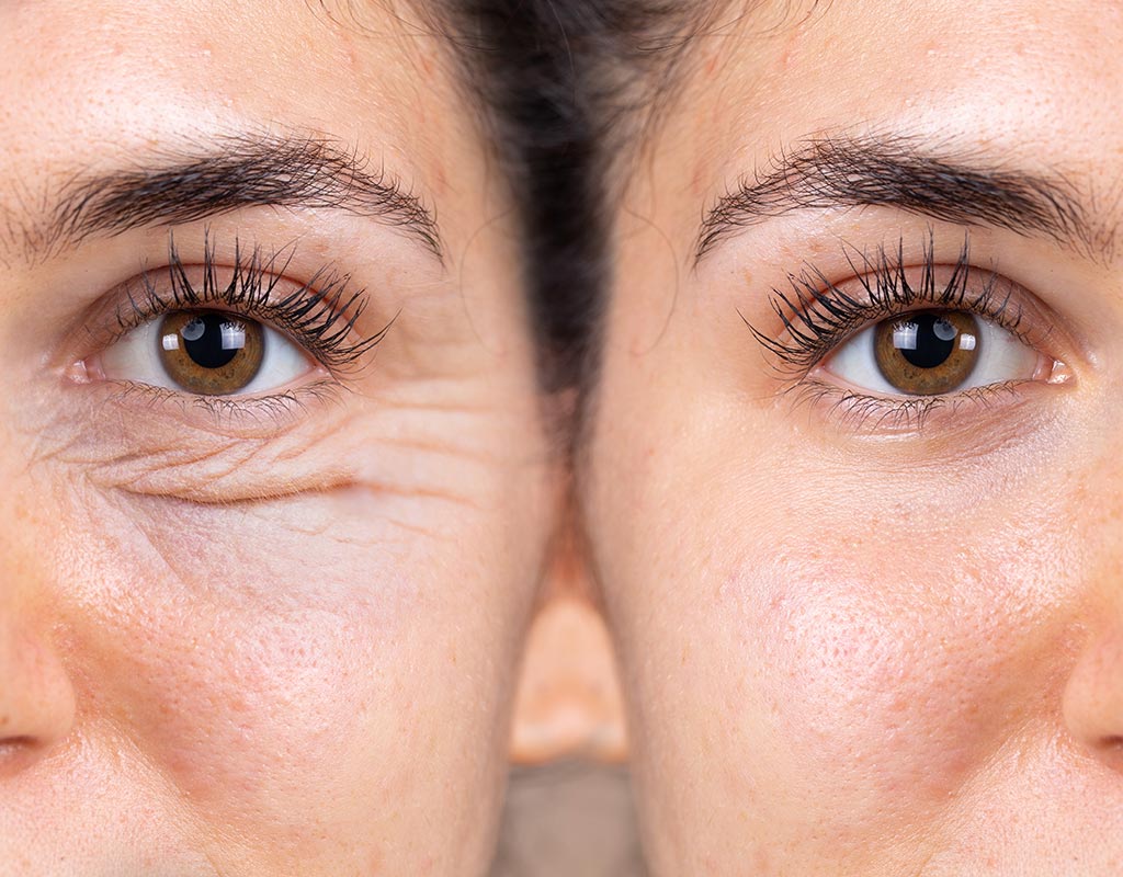 Blefaroplastia